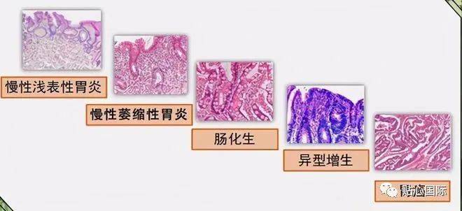 貼心醫生胃癌和胃潰瘍的早期特徵相似如何區分胃鏡活檢告訴你