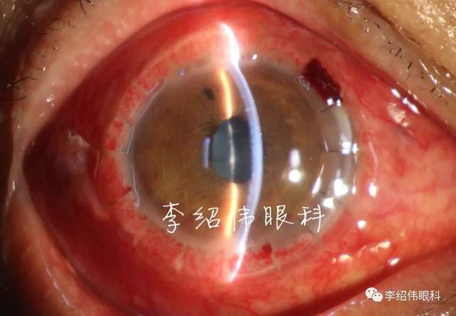 57岁男士角膜移植术后真菌复发 求助北京爱尔英智眼科医院_视力_治疗