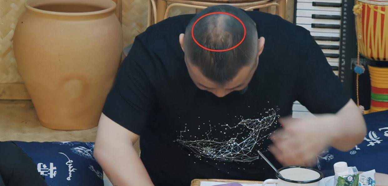 原创35岁岳云鹏近照疑秃顶面容憔悴赘肉多颅顶头发快掉没
