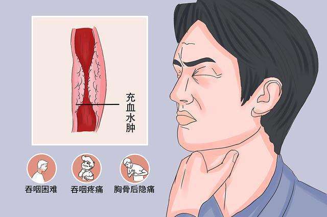 因忽略喉咙的不适差点失去生命