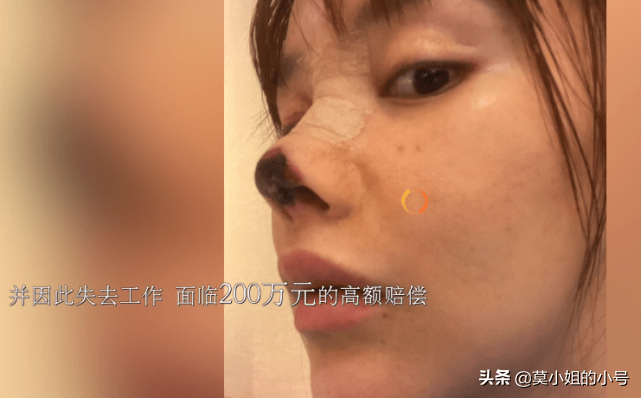 原创女星高溜谈整容失败我有容貌焦虑症鼻尖恢复不佳曾想过自杀