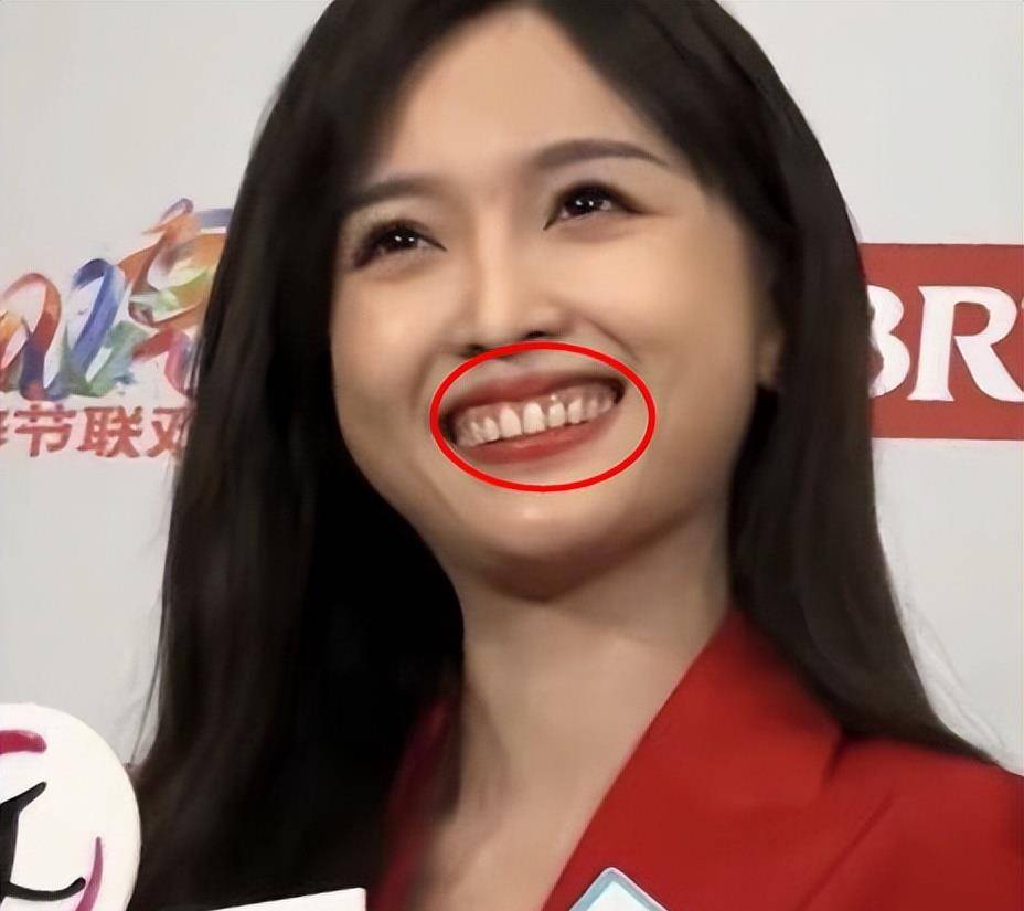 吴宣仪绝对是牙齿贴面最失败的,自从她出道以来,备受诟病的一直是她的