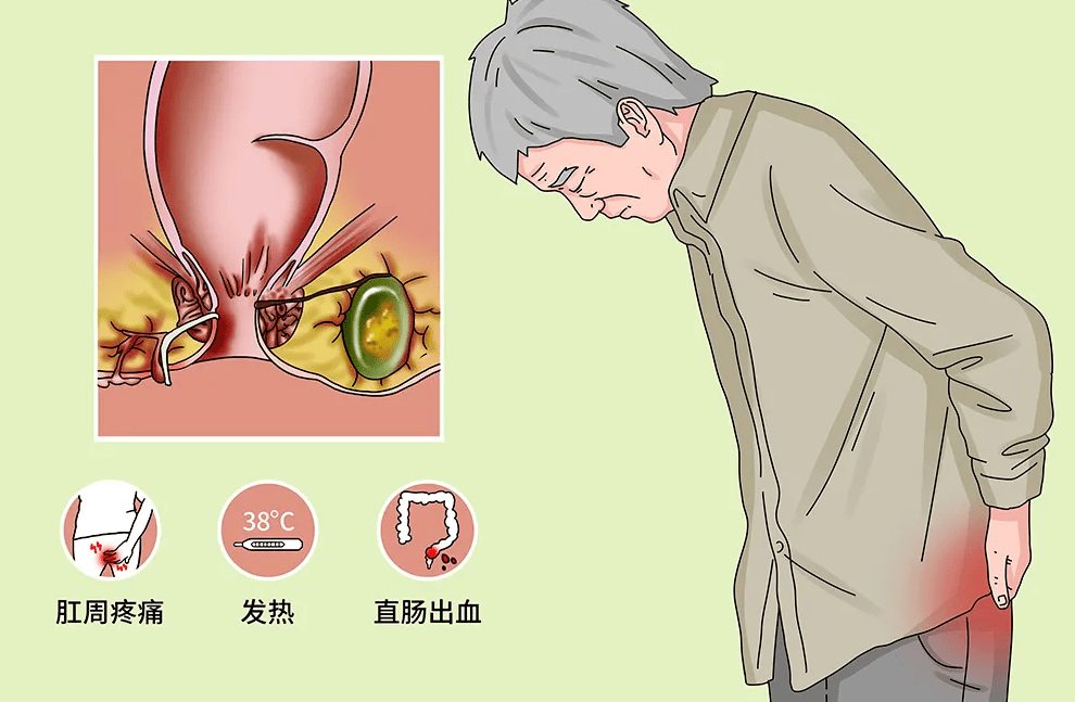 肛門_手術_症狀