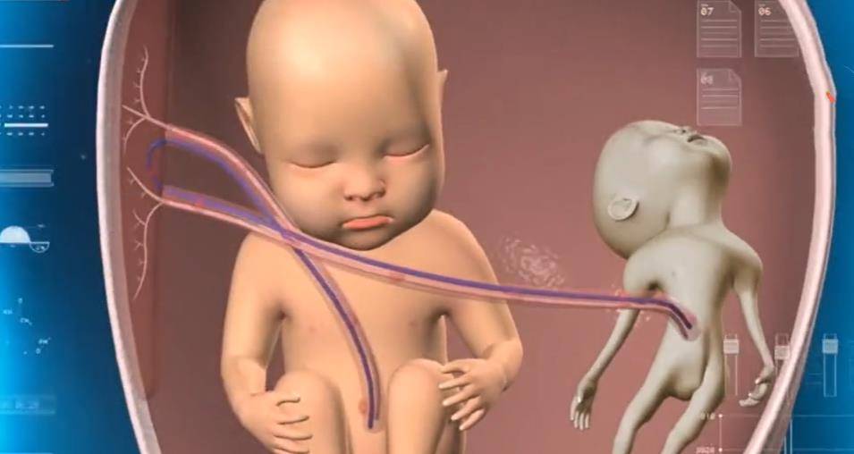 而胎儿镜手术,就是在孕妇肚子里面,对胎儿进行手术,把两个胎儿之间的
