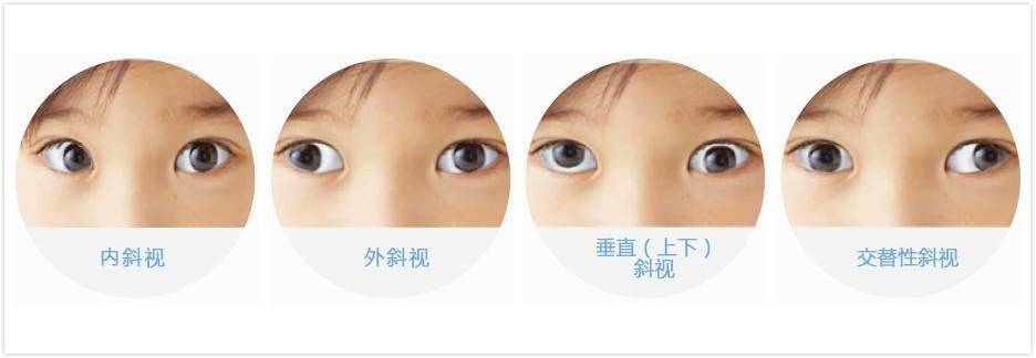 发现斜视,不要焦虑!_训练_双眼_手术
