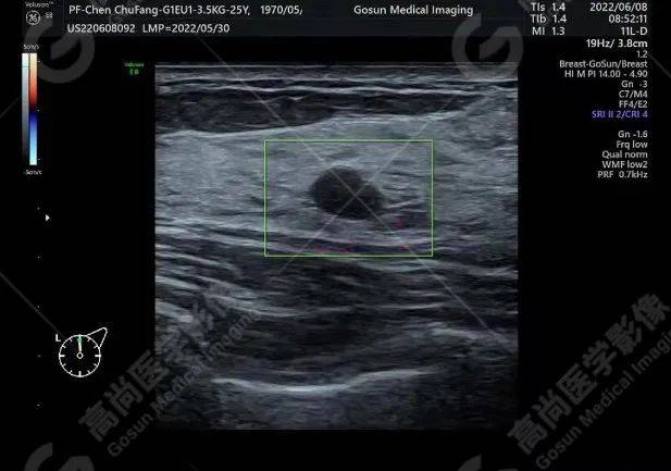 【高尚超声】乳腺纤维腺瘤_肿块_检查_乳房