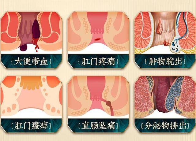 痔疮便血怎么办?不做手术的话有其他方法吗?_治疗_肛门_病症