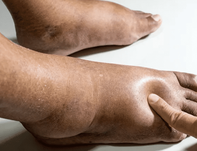 从而导致低蛋白血症,当细胞渗透压发生变化时,下肢水肿就会表现为下肢