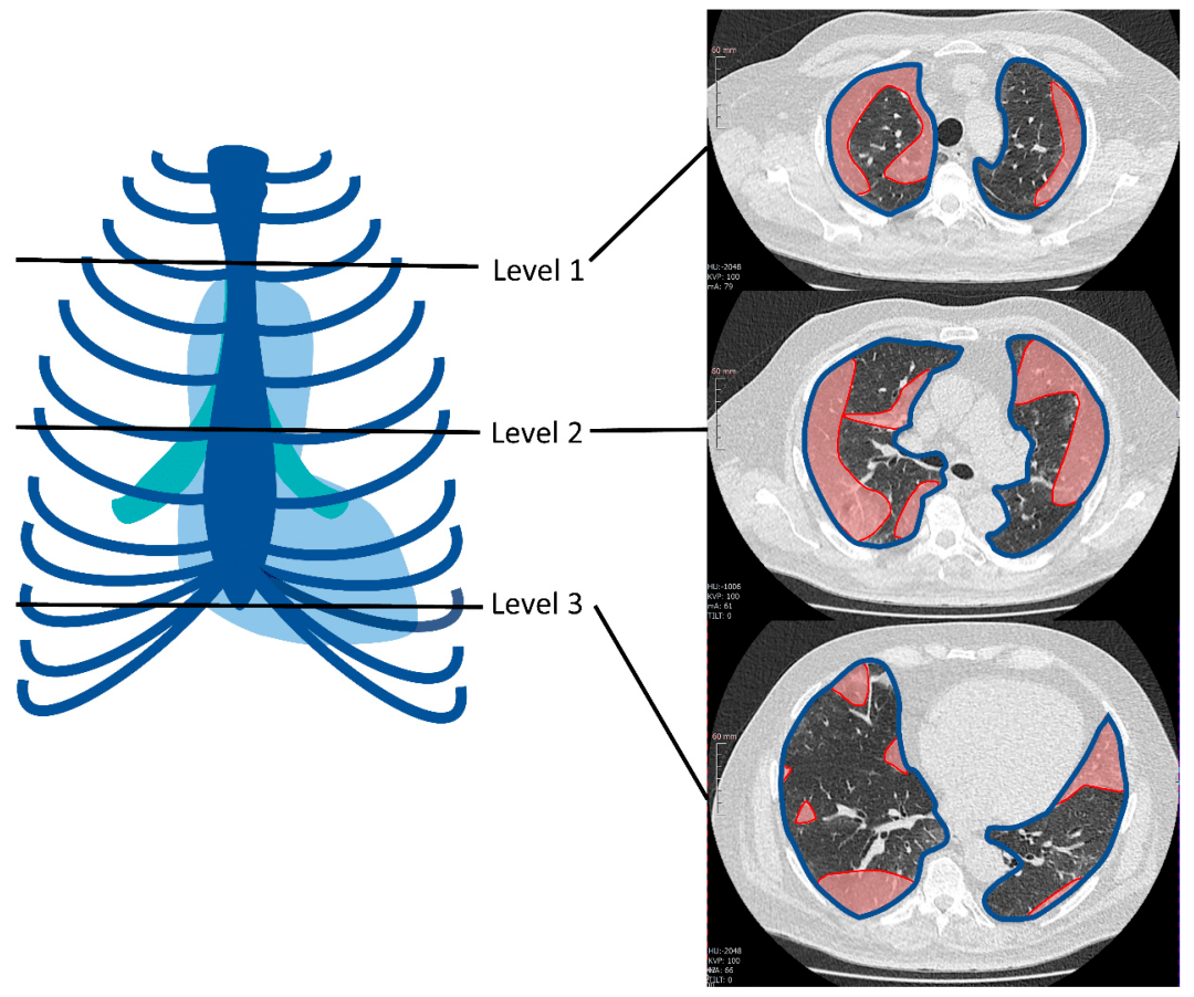 diagnosticscovid19影像學文章精選