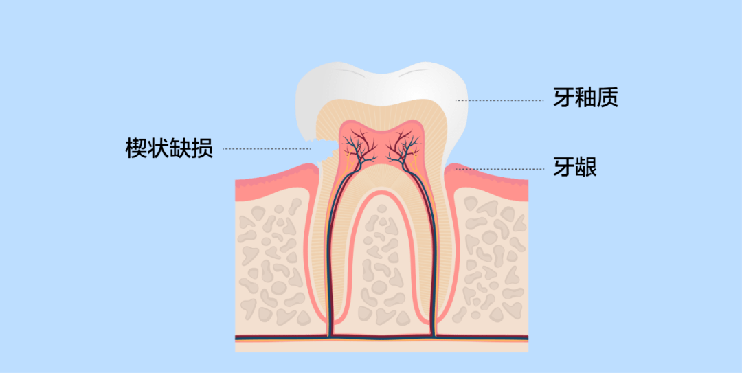 楔状缺损备洞形图解图片