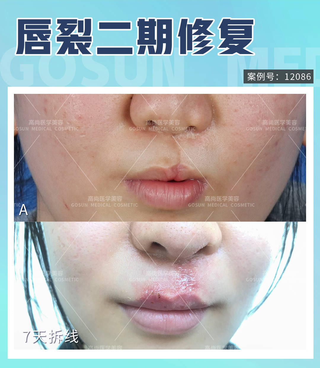 唇裂二期修复手术可以毫无痕迹地修复好吗