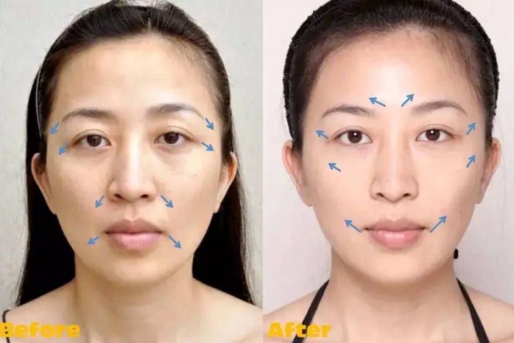 广运整形告诉你选择大拉皮还是小拉皮,二者区别有多大?