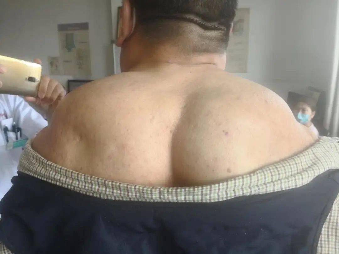 白酒红酒啤酒来者不拒连喝30多年漳州一大叔患罕见马德龙病