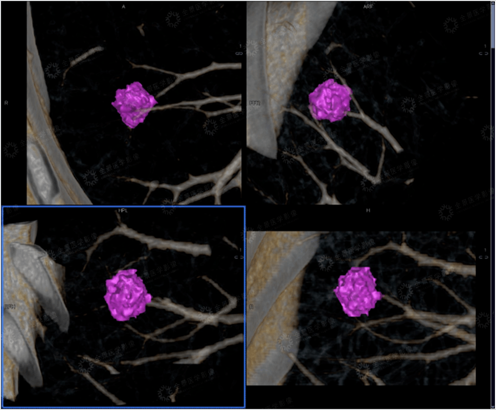 ssd三维重建 伪彩标记 局部放大,显示病灶与胸膜,血管空间关系全景