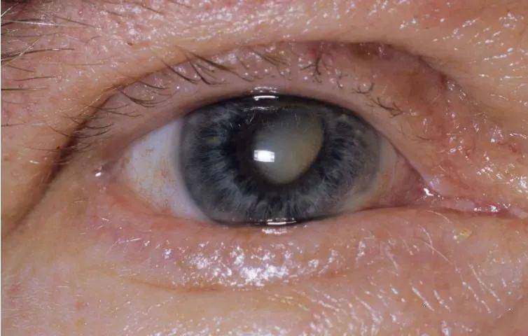 白内障必须成熟才可以做手术?_晶状体_患者_视力