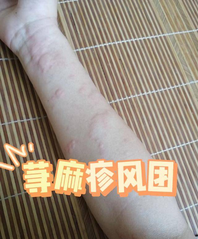 荨麻疹内行人的真实自述!消疹止痒就这么简单!前后才花7天!