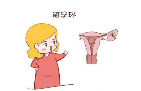 女性避孕环原理图片