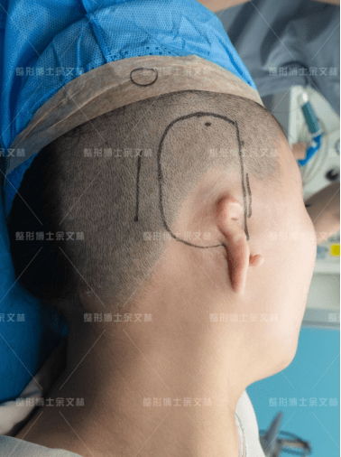 耳女生常年用头发遮盖小耳,耳再造后终于拥有精致五官_耳朵_患者_手术