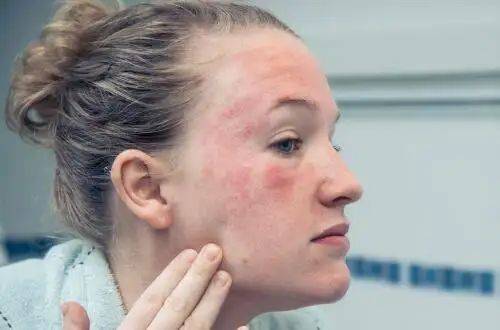 脸上红痒,刺痛,灼热等症状,可以引起人们皮肤过敏的原因包括花粉,灰尘