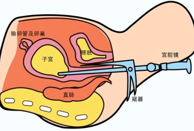 腹腔镜取环手术过程图图片