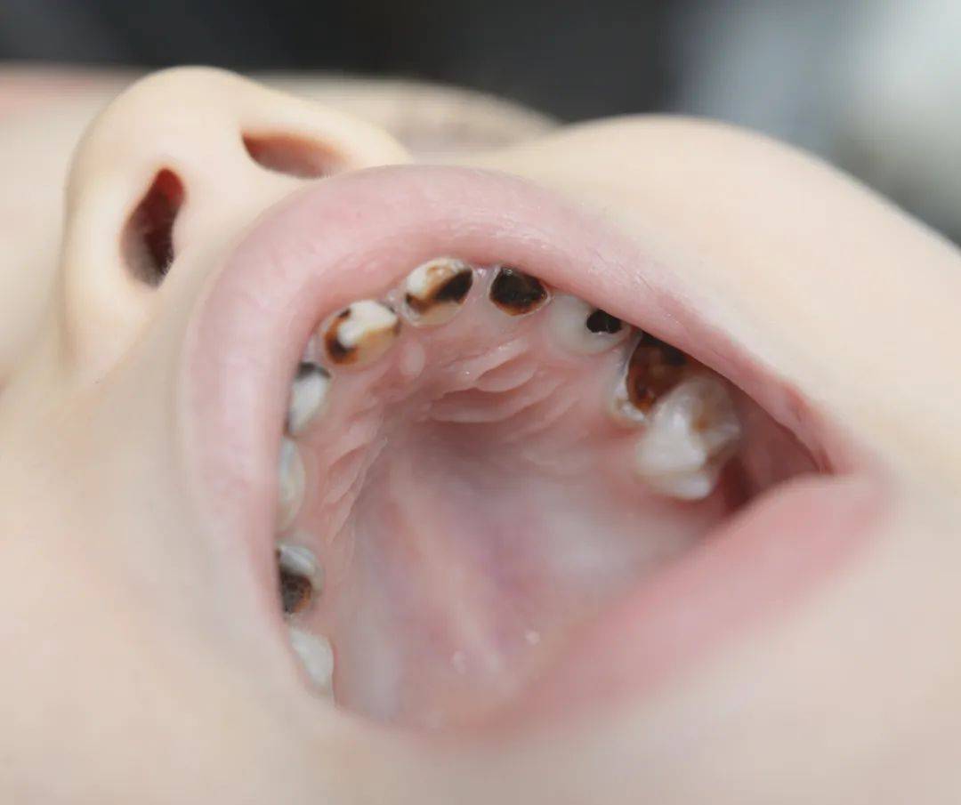婴儿长牙牙龈发黑的图图片