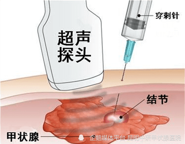 甲状腺结节细针穿刺活检是安全可行的