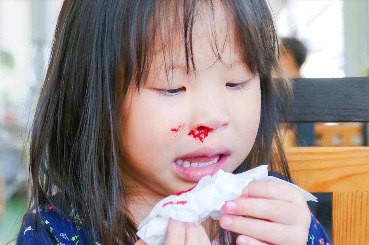 孩子流鼻血怎样快速止血？3步骤快速止血分享