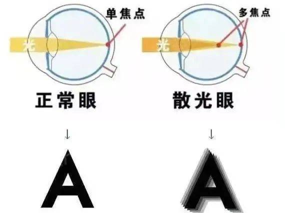 散光跟正常眼比,有啥区别?