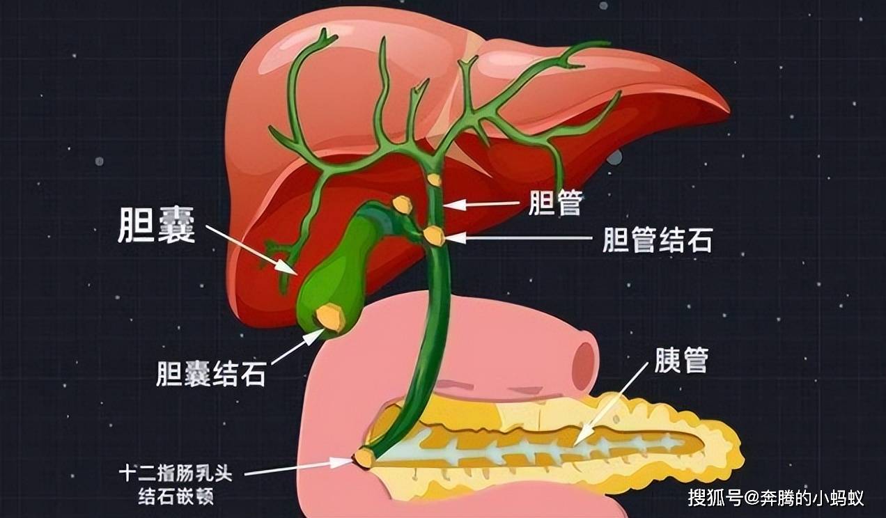 胆囊结石,胆囊息肉都有可能癌变,有这些生活习惯的人很危险!