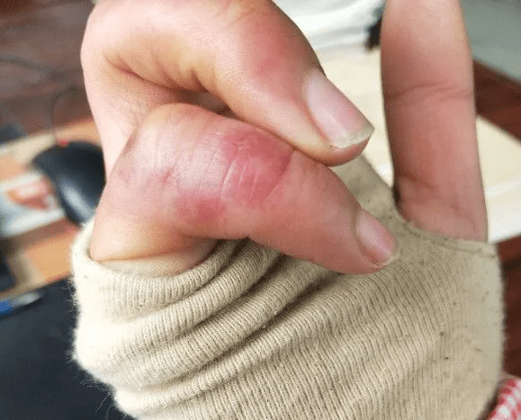 手上长疮了怎么办?农村小伙教你一招,不花一分钱三天就见效!