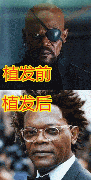 植发搞笑日常(植发搞笑日常图片)