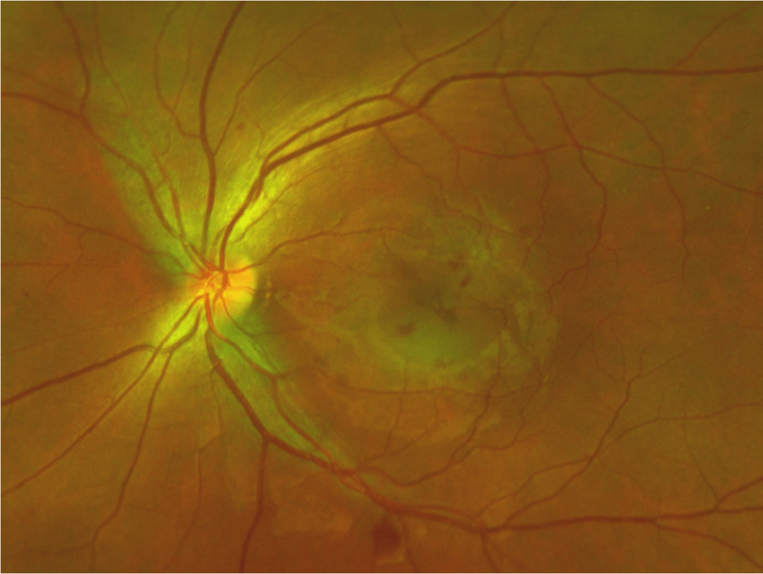 neuroretinopathy图片