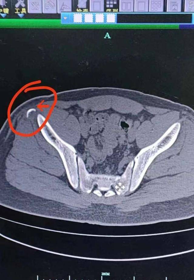 急诊外科医生在查体后发现,小宋的右髂部有些肿胀,右髋的屈伸活动部分