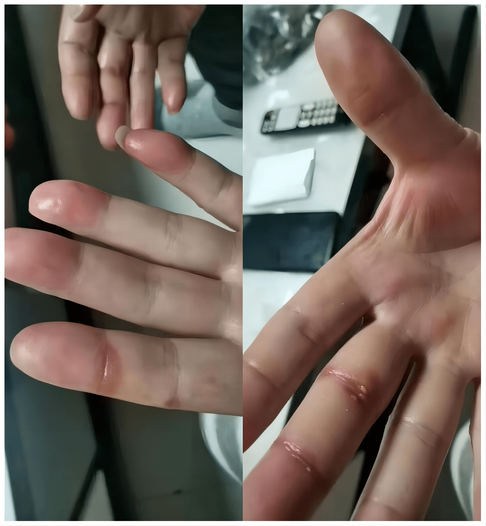 靶向药瑞戈非尼引起的手足综合征治疗案列_皮肤_症状_图片