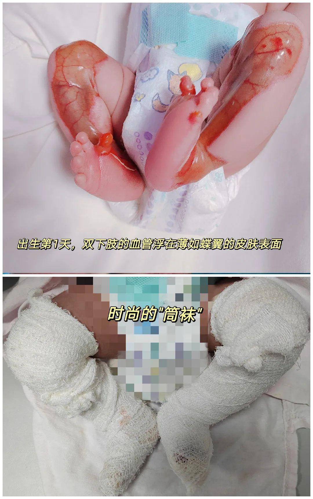 如翅翼般脆弱的蝴蝶宝贝出院了