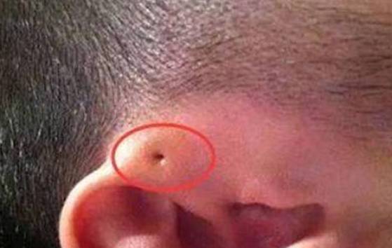 婴儿耳朵有个小眼图片图片