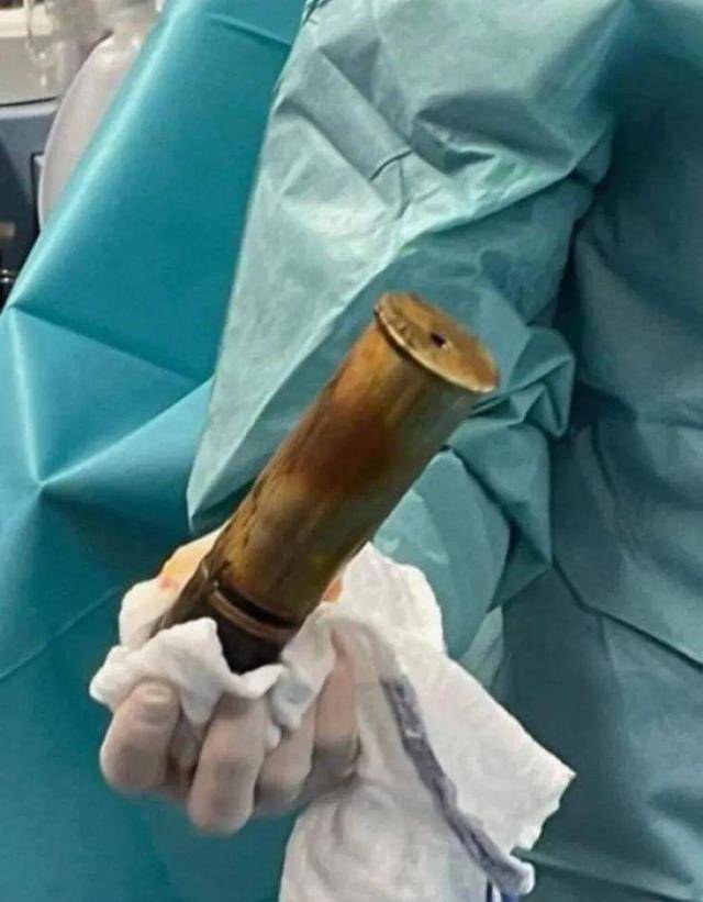 即便如此,当医生看到这枚炮弹的时候,还是暗自惊了一下:通常遇到肛门