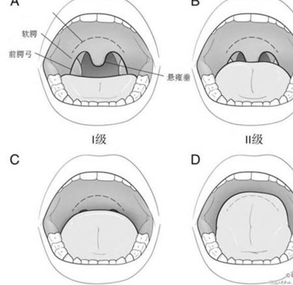 不同年龄段都会受到打呼噜的影响,比如说少儿打呼噜,可影响正常发育