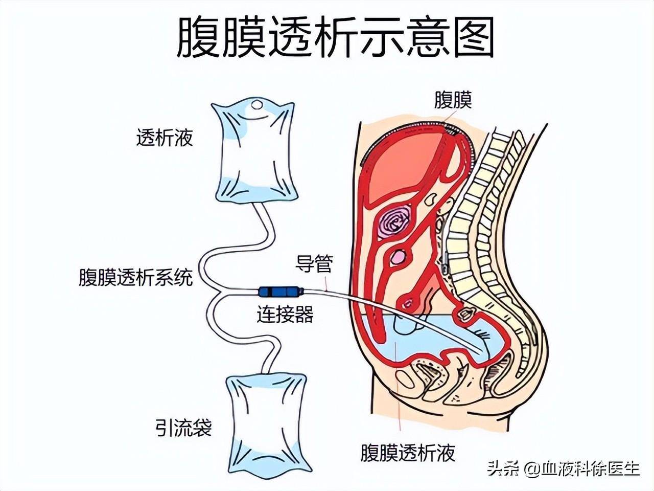 腹膜透析原理示意图图片