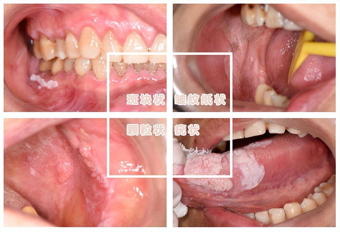 口腔白斑有多種形狀:有一些帶有絨毛狀突起,摸上去硬硬的;有一些像