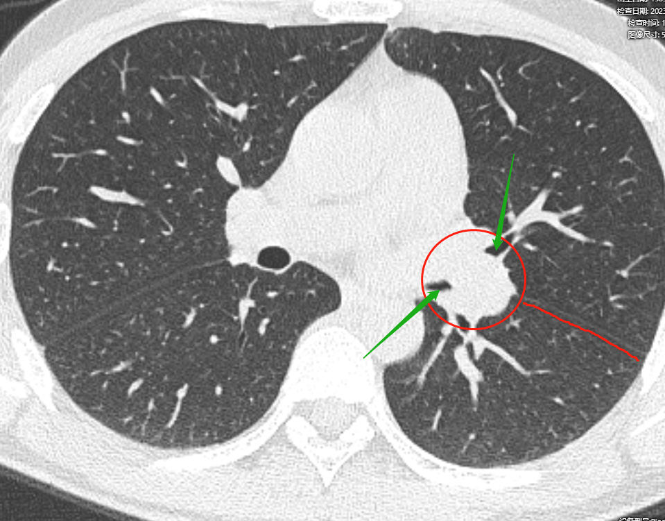 上圖為2023年1月4日的ct片,我們發現左肺門區可見高度可疑佔位性病變