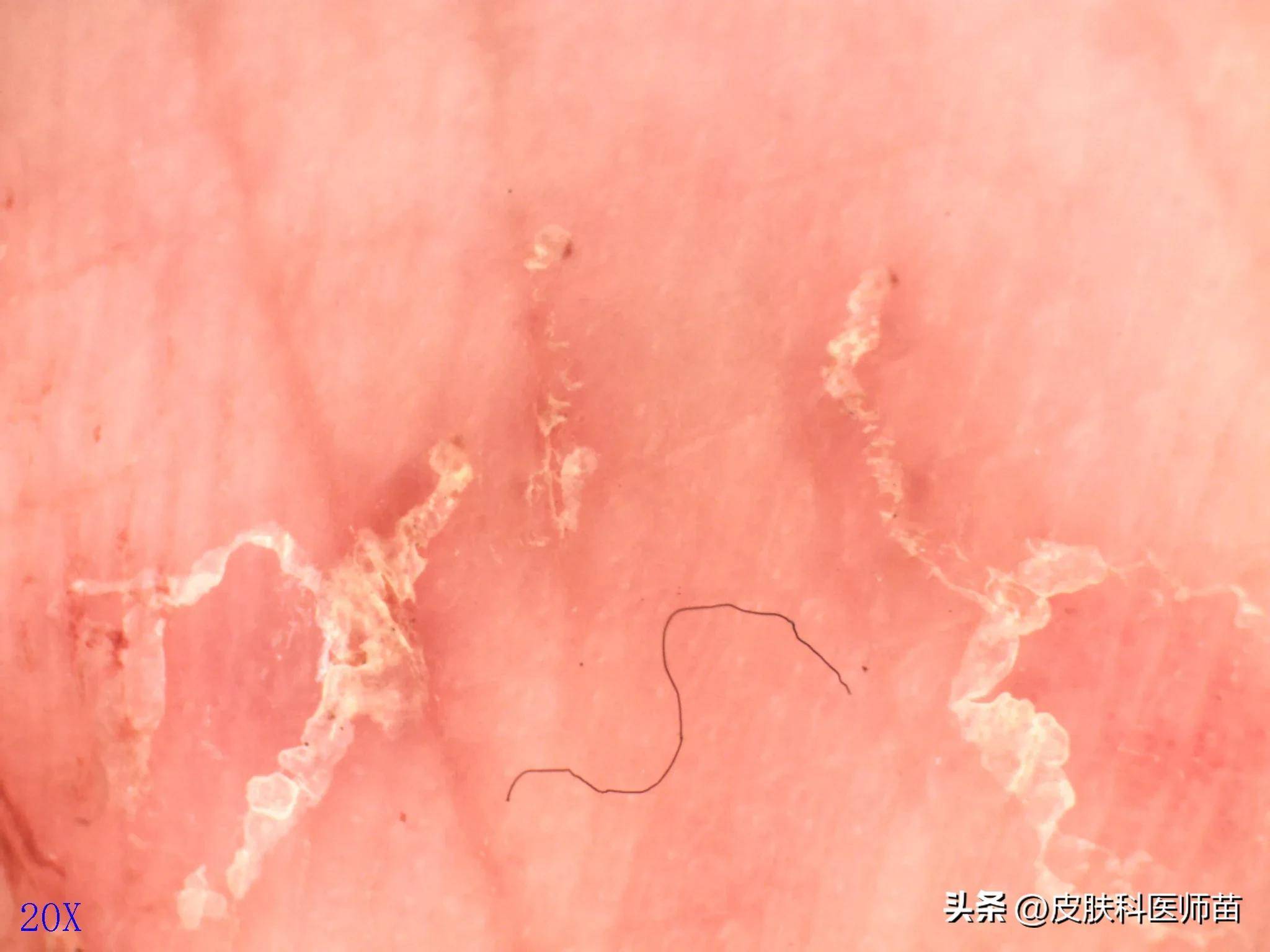 很‬明显‬的‬一条条‬疥虫‬‬打‬的‬隧道‬