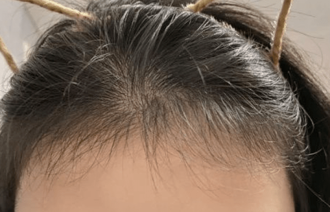 用完头发蹭蹭长!效果堪比植发!_产品_因为_绒毛