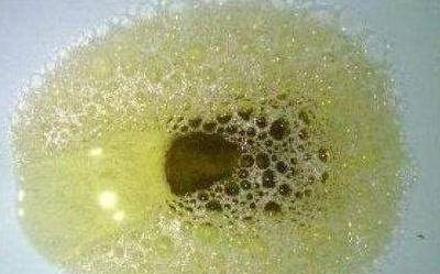 尿液是肾脏"晴雨表"?