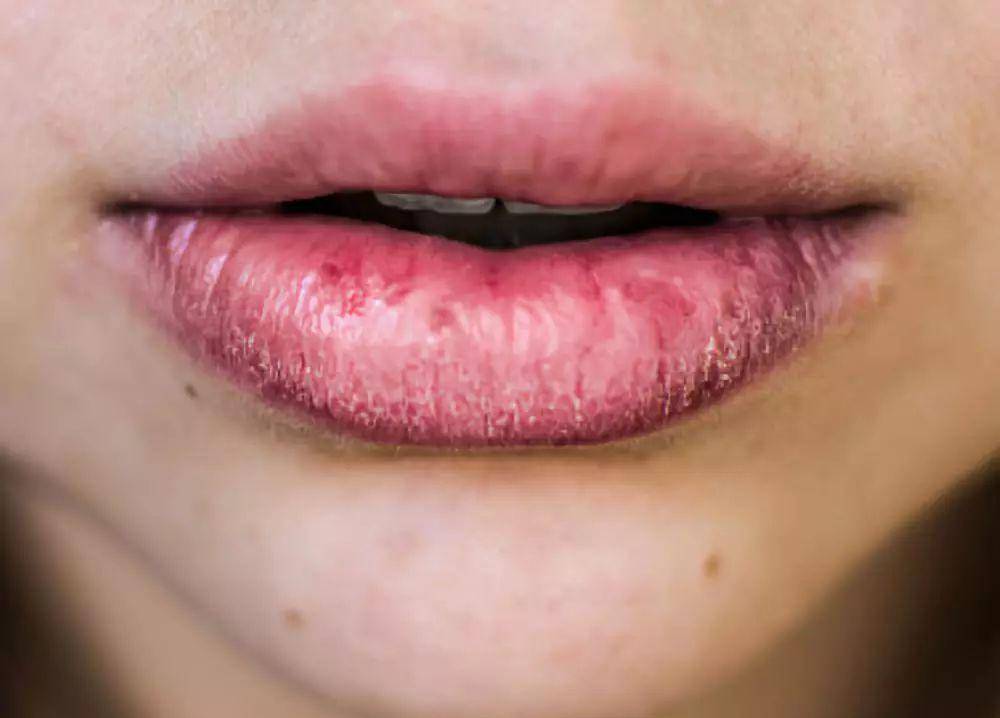 嘴唇发紫是什么原因?图片