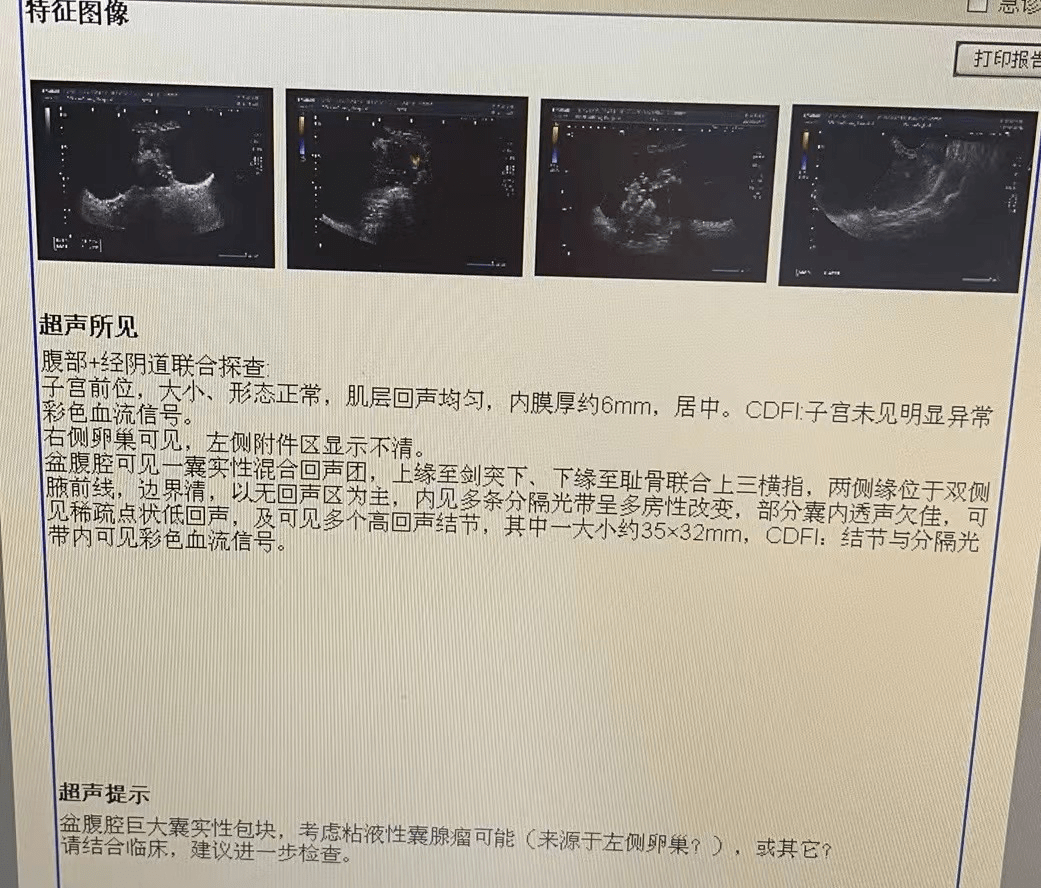 耻骨联合分离超声图片图片