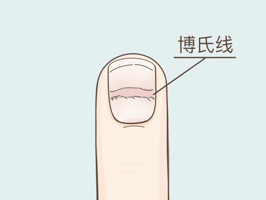 73 向左滑动查看真实图片博氏线是指甲上出现横线凹陷的沟线.