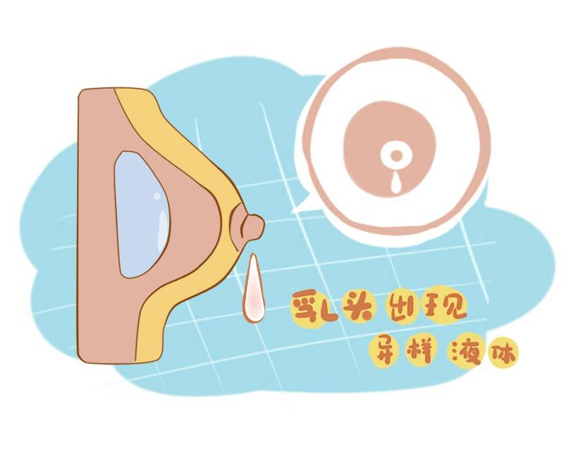 乳腺癌早期有哪些症状出现(附4个表现)