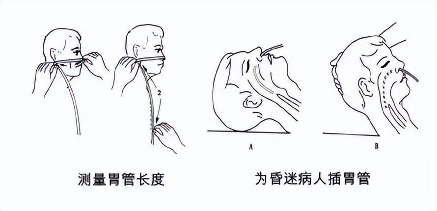 确保留置胃管成功的三种方法,你首选哪一种?_病人_患者_问题
