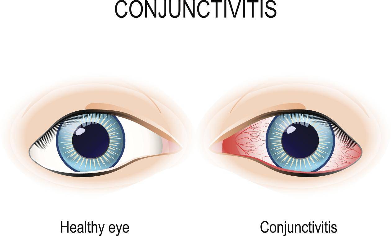 8岁女孩春天眼睛总爱痒痒痒原来是过敏性结膜炎！_搜狐网, image size:1260x759